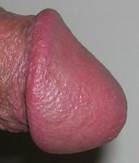 Beschnittener Penis (Foto: wikimedia / BigBoris)