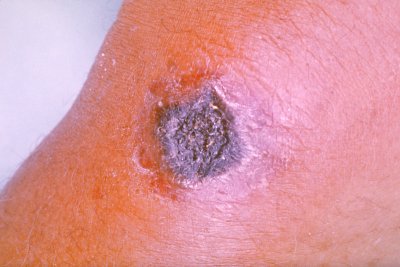 Milzbrandinfektion am Unterarm (Foto: CDC)